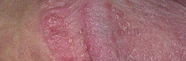 Dry skin and ulcer on the head of the penis after using baking soda