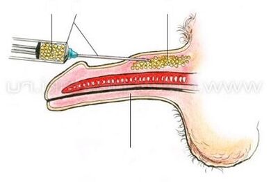 Injectable penis enlargement