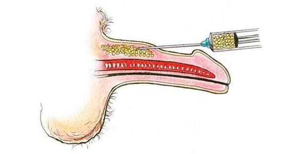 muscle tissue transfer for penis enlargement